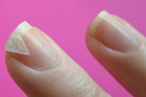 Cracks on the fingers near the nails: causes, treatment